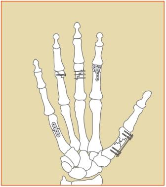 Hand Fracture Procedures