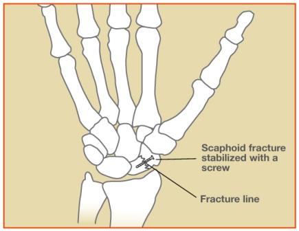 Scaphoid Fracture Procedures