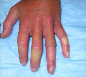 Image of cold hand