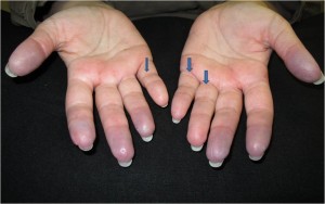 Image of warmed up hands